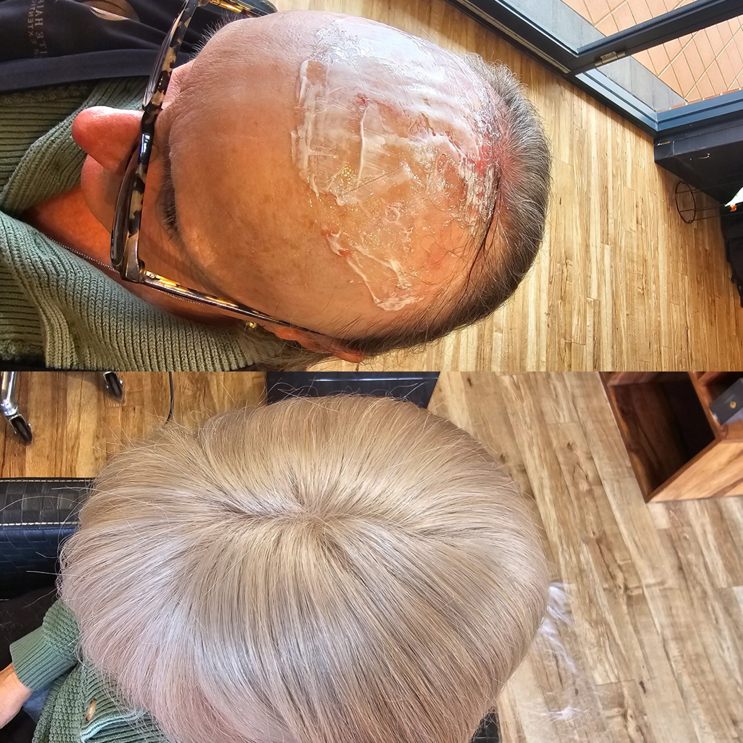 Advance Cranial Prosthesis